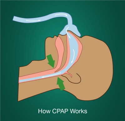 Article Image: treat-sleep-apnea-cpap-therapy